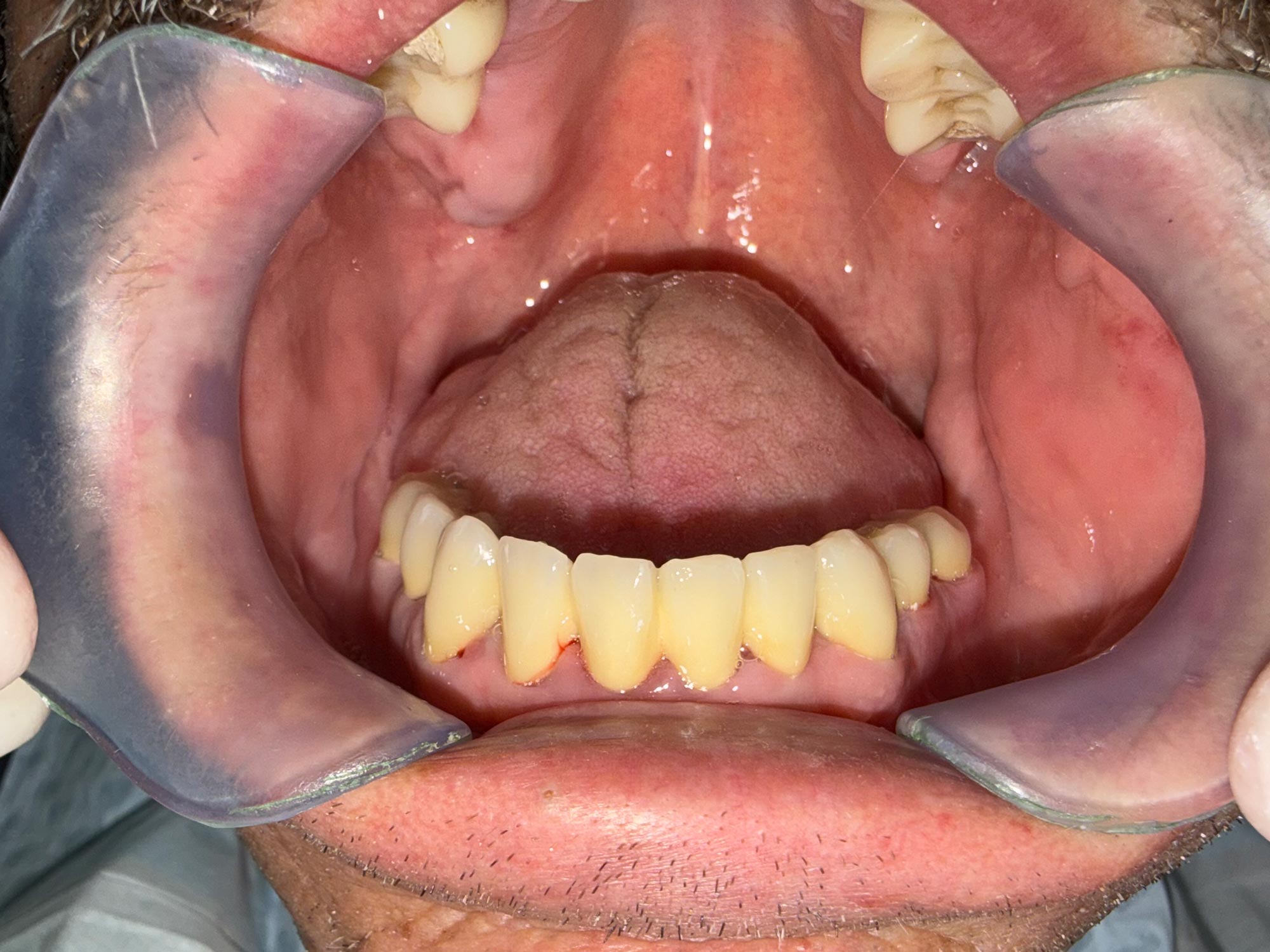 Der Patient mit einem neuen Zahnersatz aus unserer ungarischen Zahnklinik