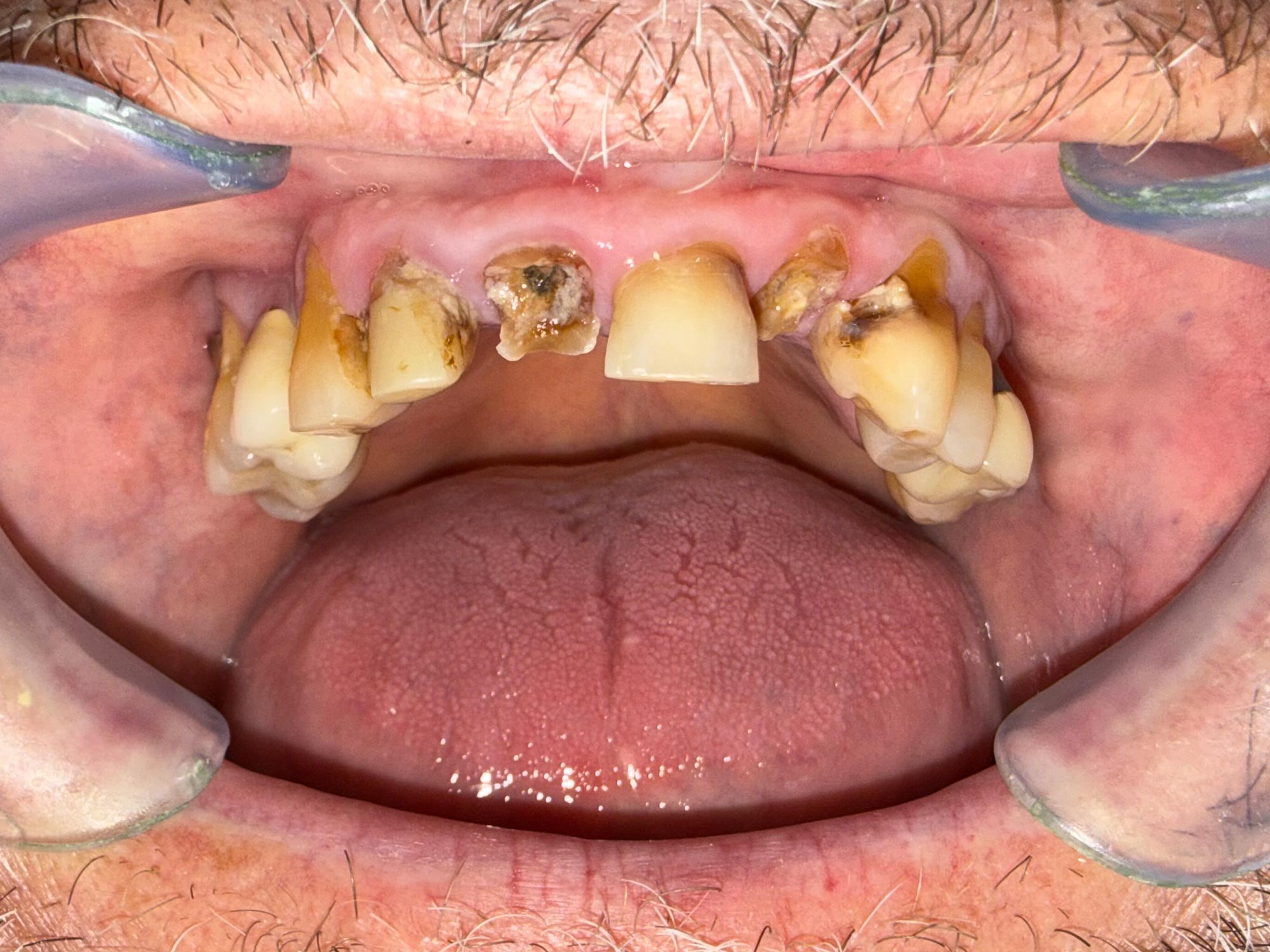 Ein Foto der Zähne eines Patienten bevor der Behandlung