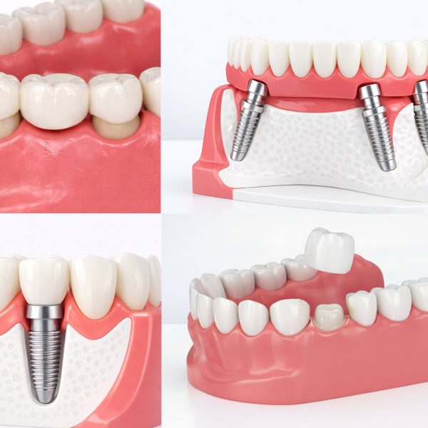 Zahnersatz Ungarn (Zahnbrücken, Zahnkronen, All-on-4 Implantate, Einzelimplantate)